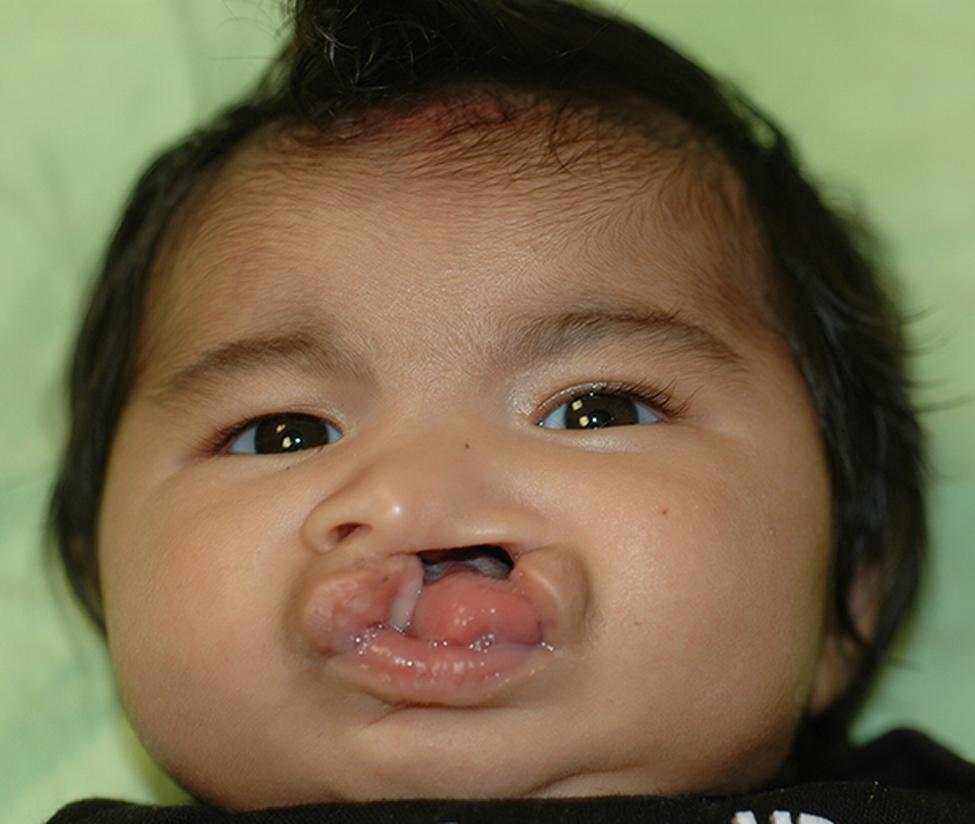 到Jae大约3个月大的时候，他需要手术来修复他的嘴唇。（照片由马里兰州马修·格雷夫（Matthew Greives）提供）